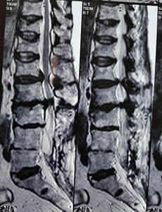 Dolor de columna guadalajara