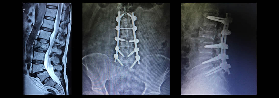 Sintomas de hernia